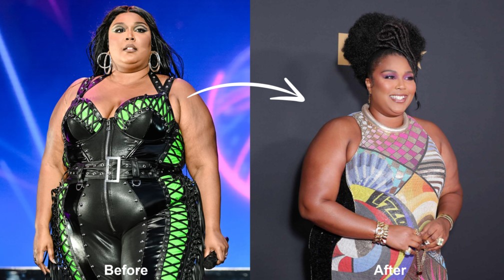 How Much Does Lizzo Weight Loss Surgery Cost in 2024?